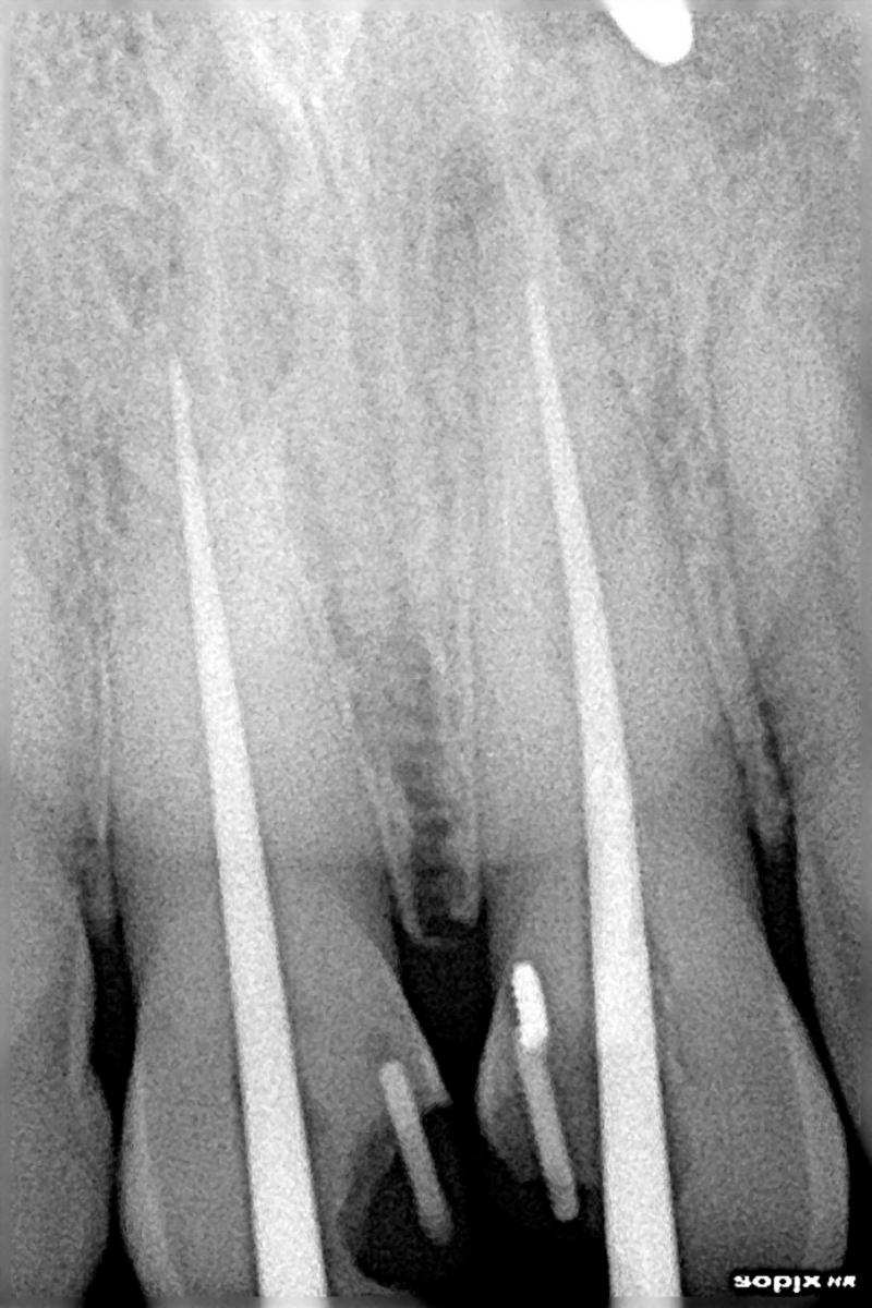 X-RAY FOR CONFIRMATION OF WORKING LENGTH IN BOTH THE FRONT TEETH