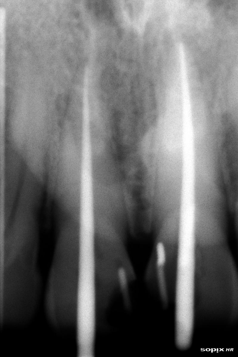 FULL WORKING LENGTH ACHIEVED FOR FINAL OBTURATION.